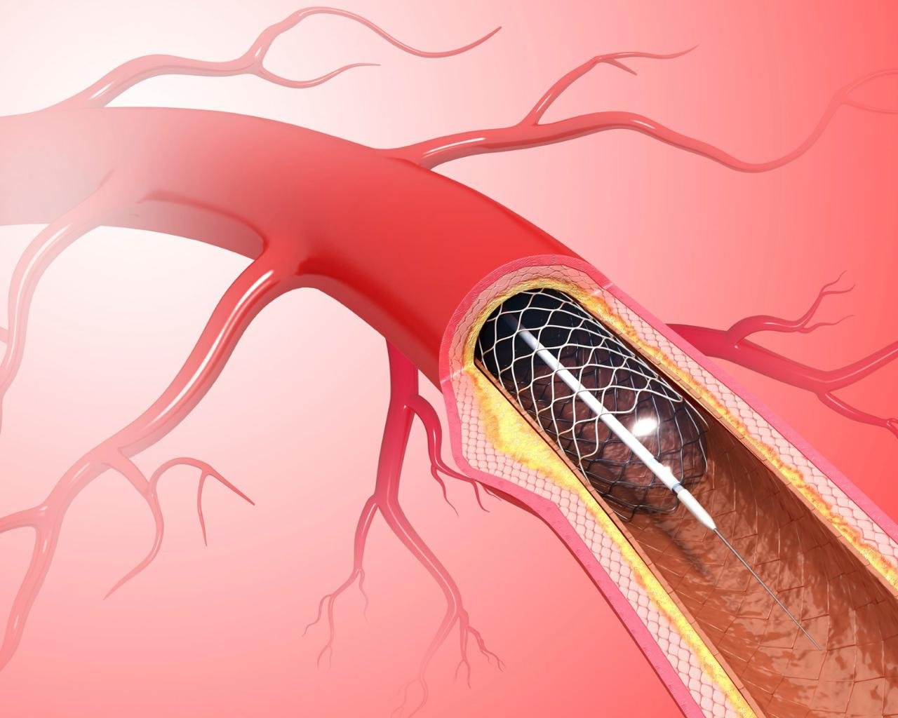 mostra uma arteria com um stent coronariano