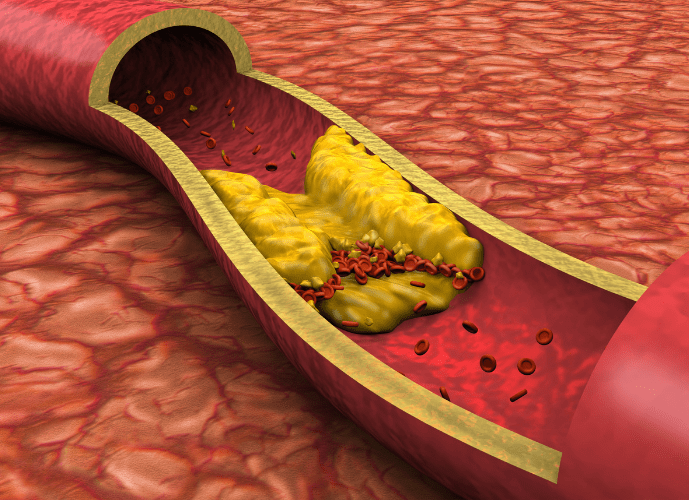a imagem mostra uma arteria entupida ocasionando infarto