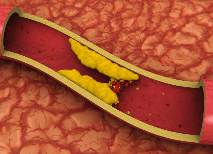arteria-entupida-infarto