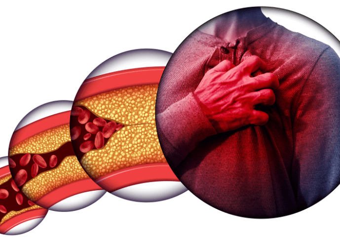 mostra as etapas de entupimento de arterias ate o infarto 